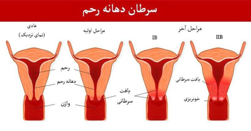 بررسی میزان آگاهی زنان باردار نسبت به غربالگری سرطان دهانه رحم